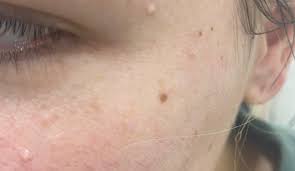 Milia vs. Whiteheads: Dermatologists Explain the Difference