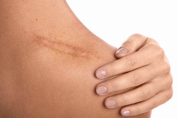Professional vs. Home Keloid Scar Treatment: Which Is Right for You?