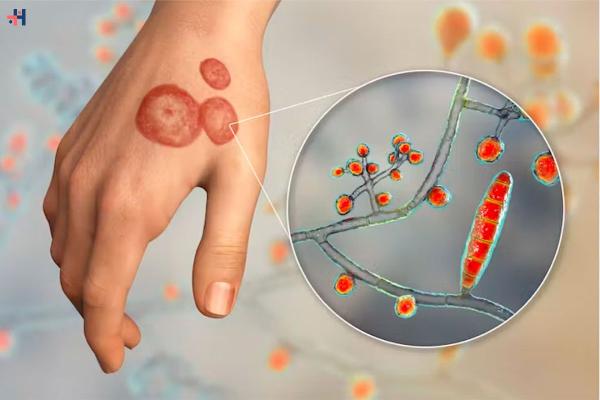 Health Alert: Emerging Drug-Resistant Fungal Infections Detected in the United States