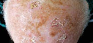 "Comprehensive Guide to Actinic Keratosis Treatment"