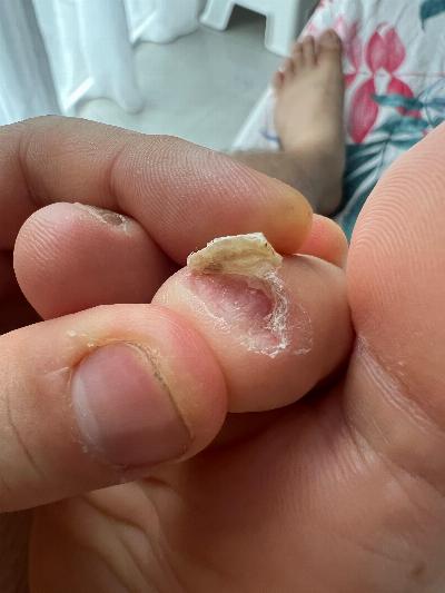 Medications for Nail Lichen Planus