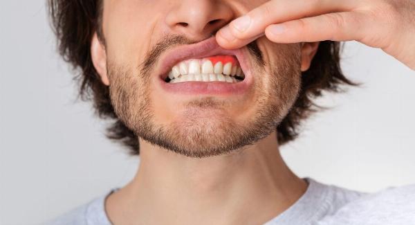 Dental Abscesses: Causes and Treatment Options