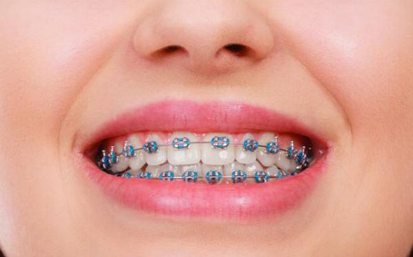 Metal Braces vs. Clear Aligners: Which Is Right for You?