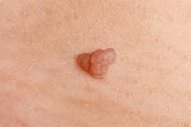 Skin Tag Removal Treatment: Safe and Simple Solutions