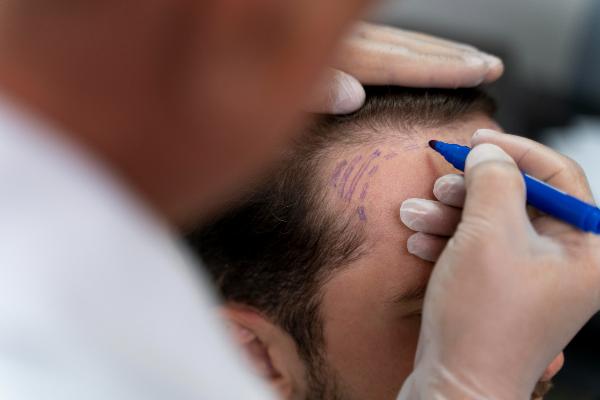 Scalp Reduction Surgery Cost - A Guide by ZandifarMD