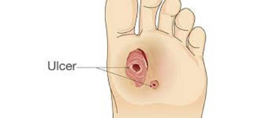 Diabetic Foot Ulcers Market: Epidemiology, Size, Share, Analysis and Forecast till (2024-2034)