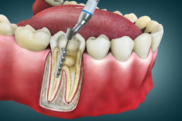 Root Canal Treatment in Turkey: A Comprehensive Overview