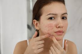 Investigating Glutathione's Effects: Can It Really Cause Acne?