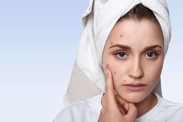 Managing Acne and Breakouts