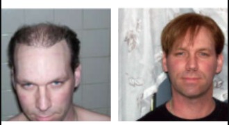 Reliable Toupees and Hair Systems: Hollywood Lace's Superior Quality