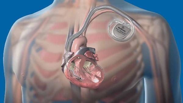 Cardiac Implant Industry: Know the Drivers and Barriers Of Cardiac Implant Market for 2024