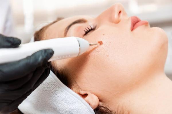 Cost-Effective Skin Wart Removal Options in Dubai Expert Insights