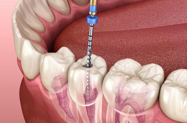 Everything You Need to Know About Root Canal Therapy in Dubai