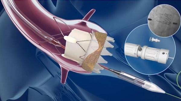 Interventional Cardiology Devices Market Size, Share, and Trends: Forecast