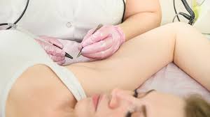 Dubai Hair Removal Experts Electrolysis & Laser Treatments for Long-Lasting Results