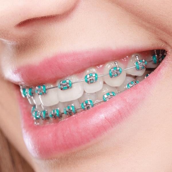 The Latest Innovations in Dental Braces in Dubai