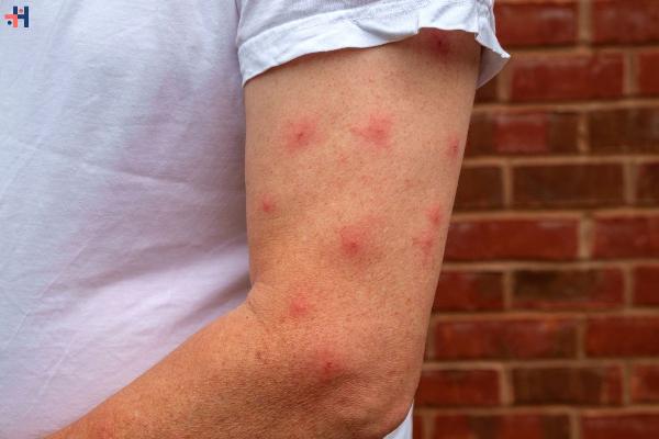 Understanding Spider Bites: Symptoms, Treatment, and Prevention