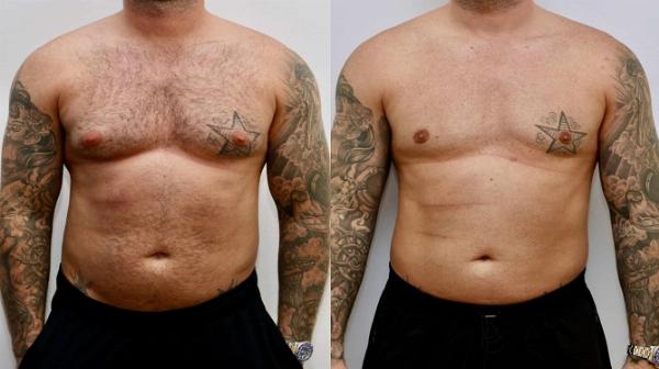 Step-by-Step Recovery Guide After Gynecomastia Surgery
