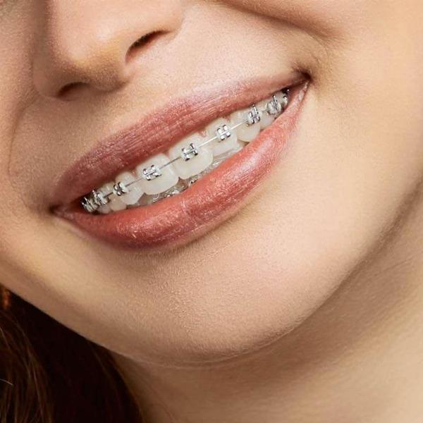 Innovative Technologies in Braces Treatment in Dubai