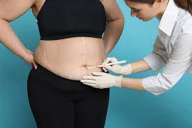 Dubai's Competitive Landscape in Bariatric Surgery Costs: What You Need to Know pen_spark