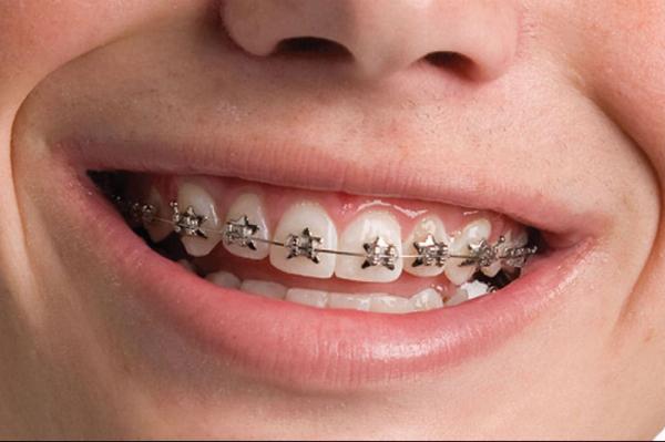 A Comprehensive Guide to the Best Dental Braces in Dubai