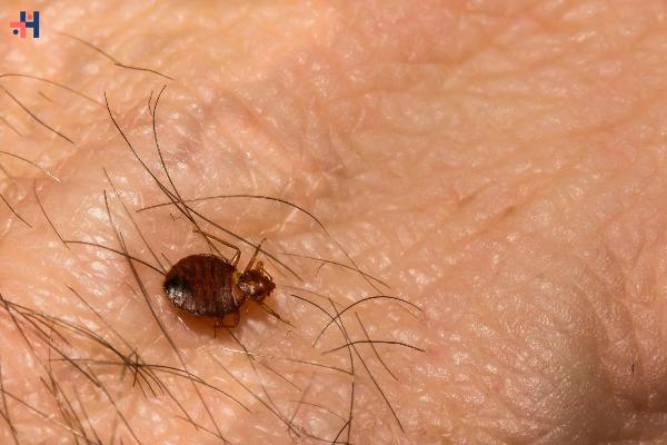 Bed Bug Bites Symptoms: Identification, Treatment, and Prevention