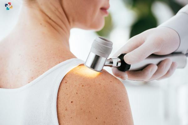 Immunotherapy for Melanoma: A Breakthrough in Cancer Treatment