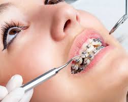 Do Dental Braces Affect Speech?