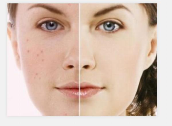 Acne Scar Treatment in Dubai