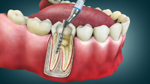 Understanding Root Canal Treatment: A Comprehensive Guide