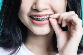 From Crooked to Confident: My Journey at a Dental Braces Clinic