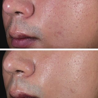 Pico Laser Treatment Non-Invasive Skin Renewal