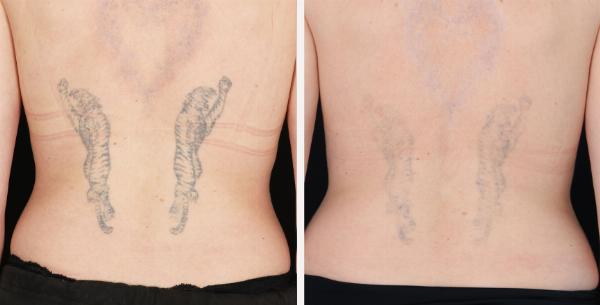 Unleash Your True Canvas Laser Tattoo Removal