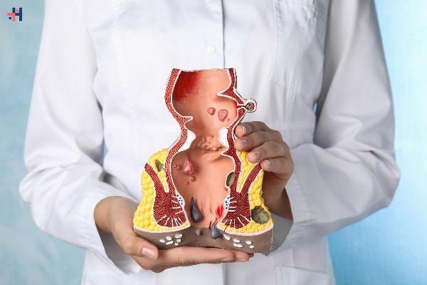 Effective Hemorrhoid Treatment: Options, Remedies, and Prevention Tips