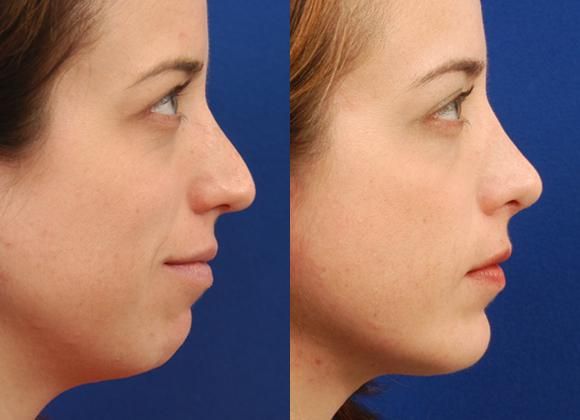 Are Facial Implants Painful? Exploring Comfort and Patient Experience