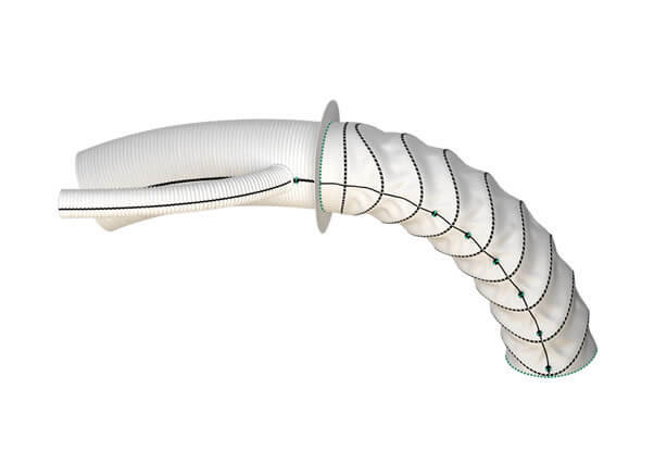 Benefits and Advantages of Endovascular Medical Devices