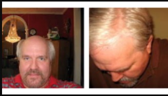 Timeless Style with Hollywood Lace: Discover the Best Mens Hair Replacement Solutions