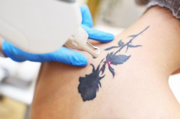 Reliable Laser Tattoo Removal in Dubai