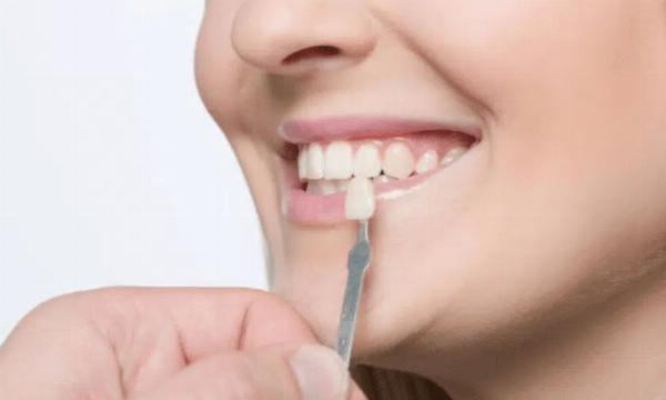 How long do dental veneers last?