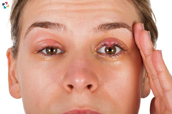Chalazion vs. Hordeolum: Understanding the Differences and Treatment Options
