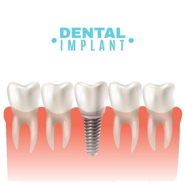 Five Reasons Dental Implants are Good for Overall Health