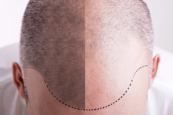 Salicylic Acid for Hair Growth: Unleash Its Potential