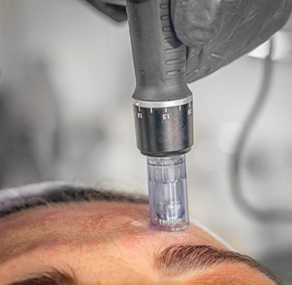 Unlocking Youthful Radiance: Can Dermapen Treatment Banish Marionette Lines?