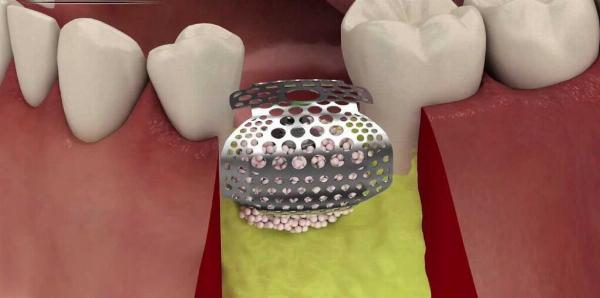 Guided Bone Regeneration Market New Product Launches and Their Impact on Market Dynamics