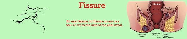 Chronic Anal Fissures Treatment in Pune: A Comprehensive Guide