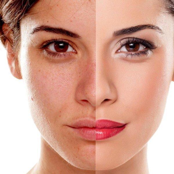 Combat Hyperpigmentation: Top Treatments in Dubai