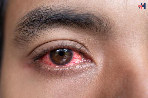 Conjunctiva of the Eye: Everything You Need to Know About This Vital Eye Membrane