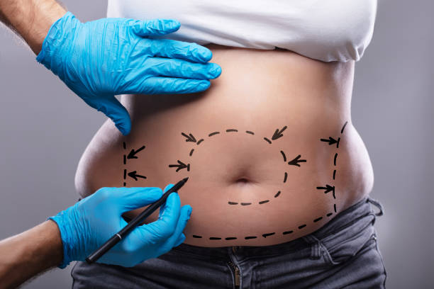 Unveiling the Cost of Body Liposuction in Riyadh: What You Need to Know