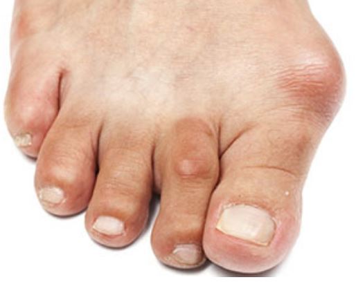One-Stitch Bunion Surgery: An Innovative Approach to Foot Health