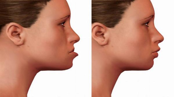 Enhancing Bite and Alignment: The Benefits of Oral and Maxillofacial Surgery